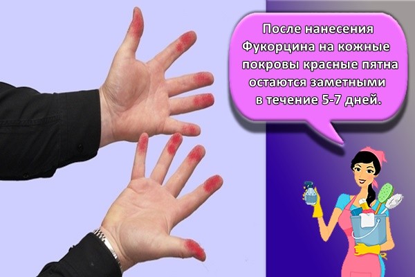 После нанесения Фукорцина на кожные покровы красные пятна остаются заметными в течение 5-7 дней.